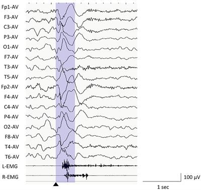 Phase Lag Analyses on Ictal Scalp Electroencephalography May Predict Outcomes of Corpus Callosotomy for Epileptic Spasms